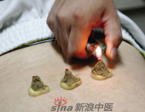 灸法的種類  你知道多少？